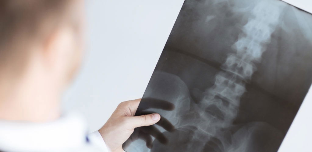 Quadriplegia and Paraplegia after a Truck Accident in New Jersey spine injury truck accident lawyer