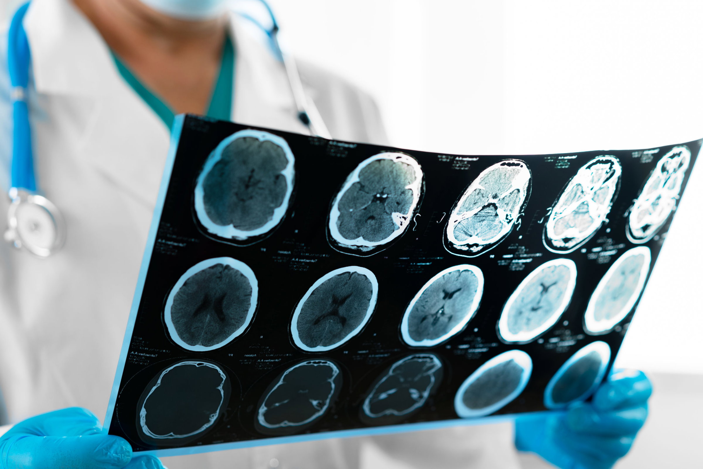 The figures relating to traumatic brain injury (TBI) in New Jersey and the nation are alarming.